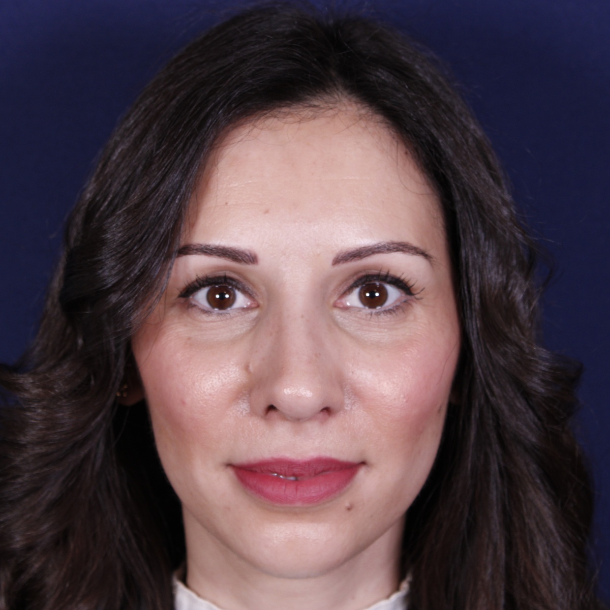 Rhinoplastie ultrasonique, résultat après intervention chirurgicale — cas opéré par le Dr Gustavo Sordo à Madrid (1)