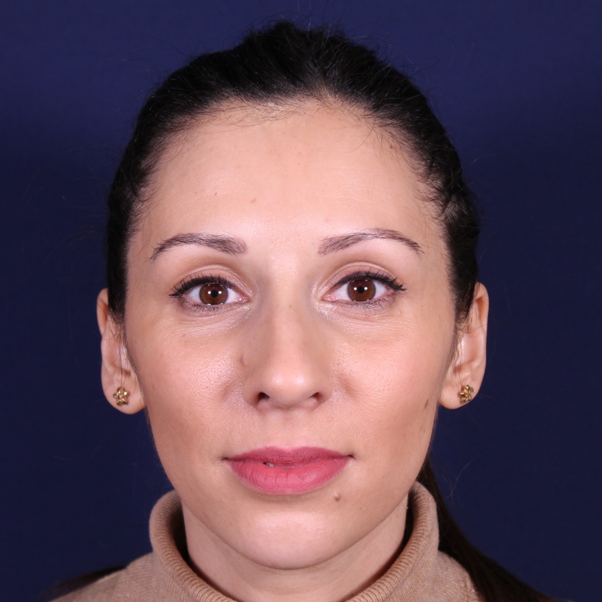 Rhinoplastie ultrasonique, avant l'intervention chirurgicale — cas opéré par le Dr Gustavo Sordo à Madrid (1)