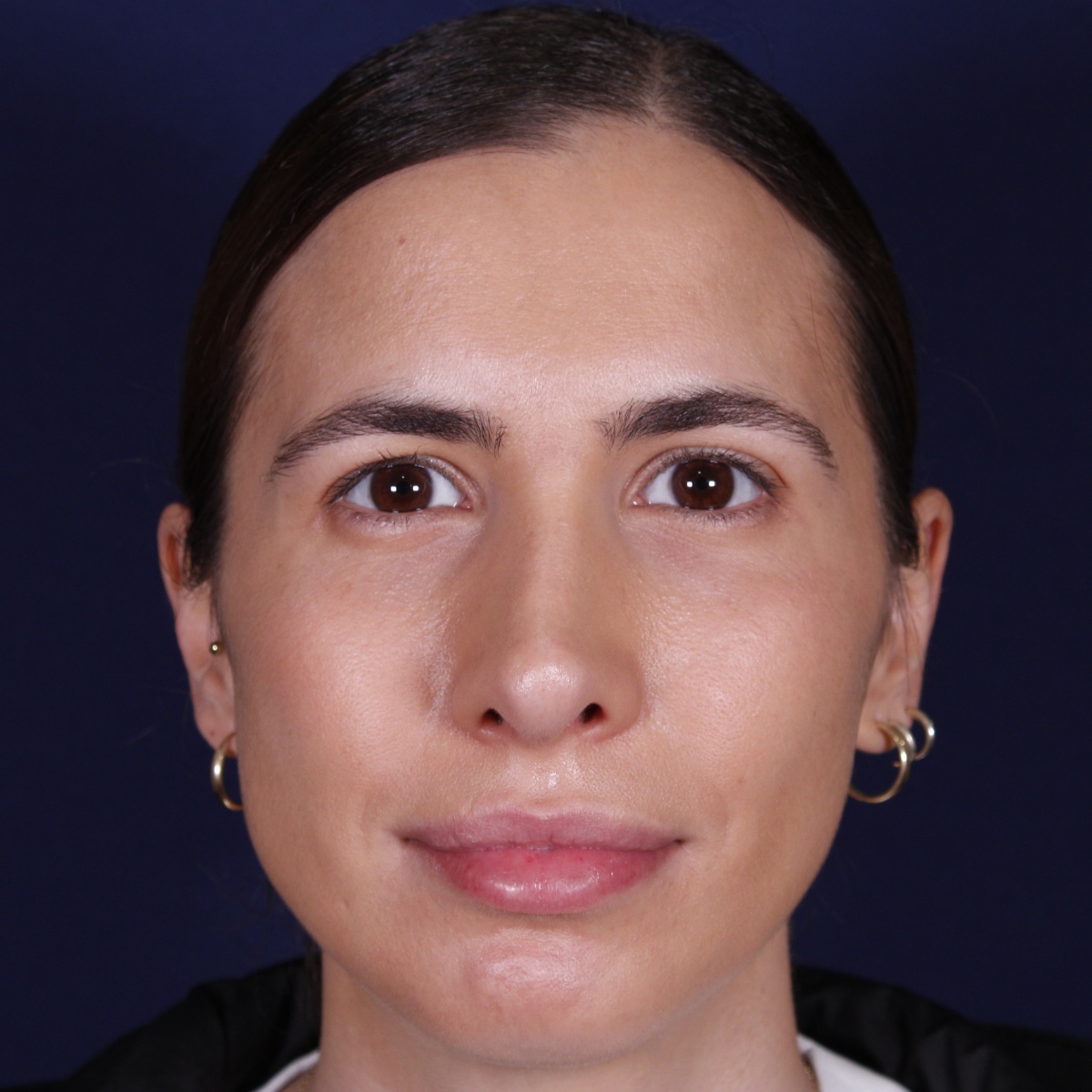 Rinoplastia ultrasónica, antes de la cirugía — caso operado por el Dr. Gustavo Sordo en Madrid (1)