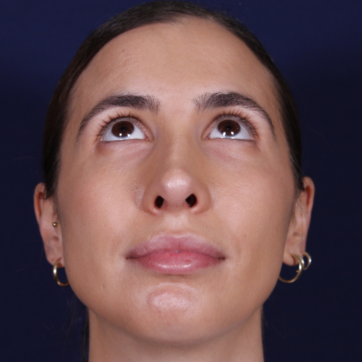Rinoplastia ultrasónica, resultado tras la cirugía — caso operado por el Dr. Gustavo Sordo en Madrid (3)