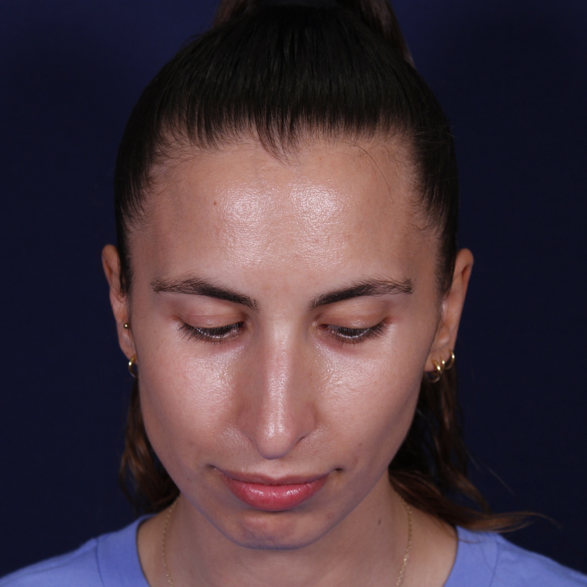 Rinoplastia ultrasónica, antes de la cirugía — caso operado por el Dr. Gustavo Sordo en Madrid (2)