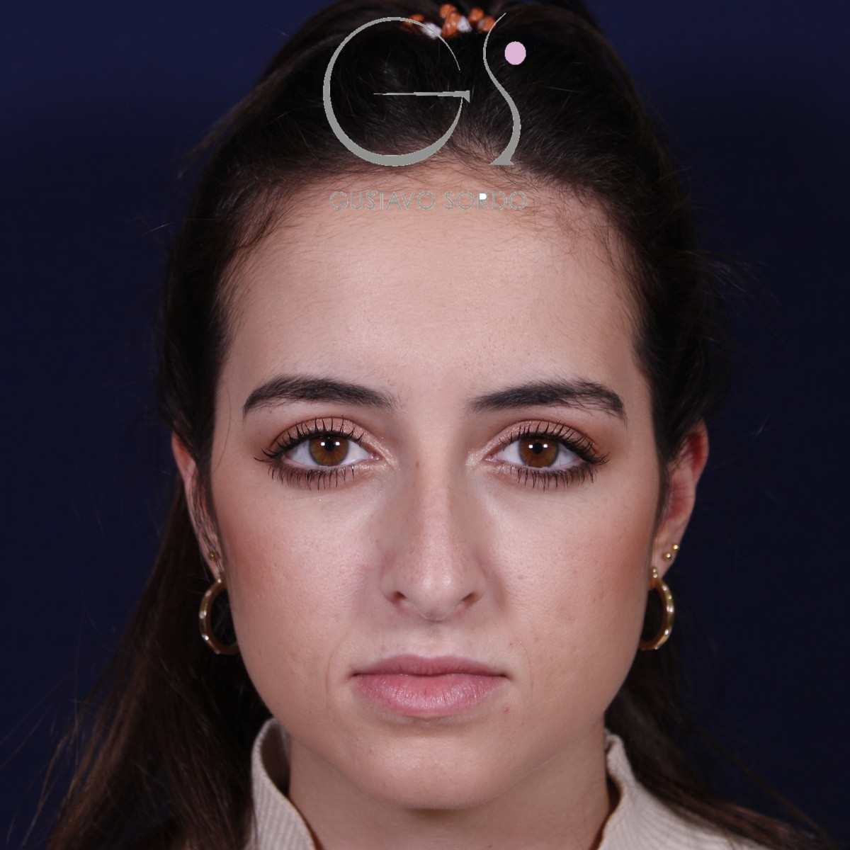 Rinoplastia ultrasónica en mujer con nariz aguileña, antes de la operación (1)