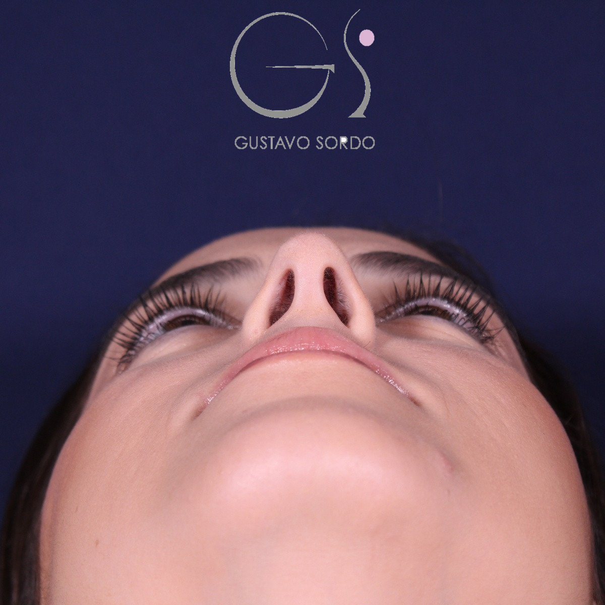 Rinoplastia ultrasónica en mujer con nariz aguileña, antes de la operación (8)