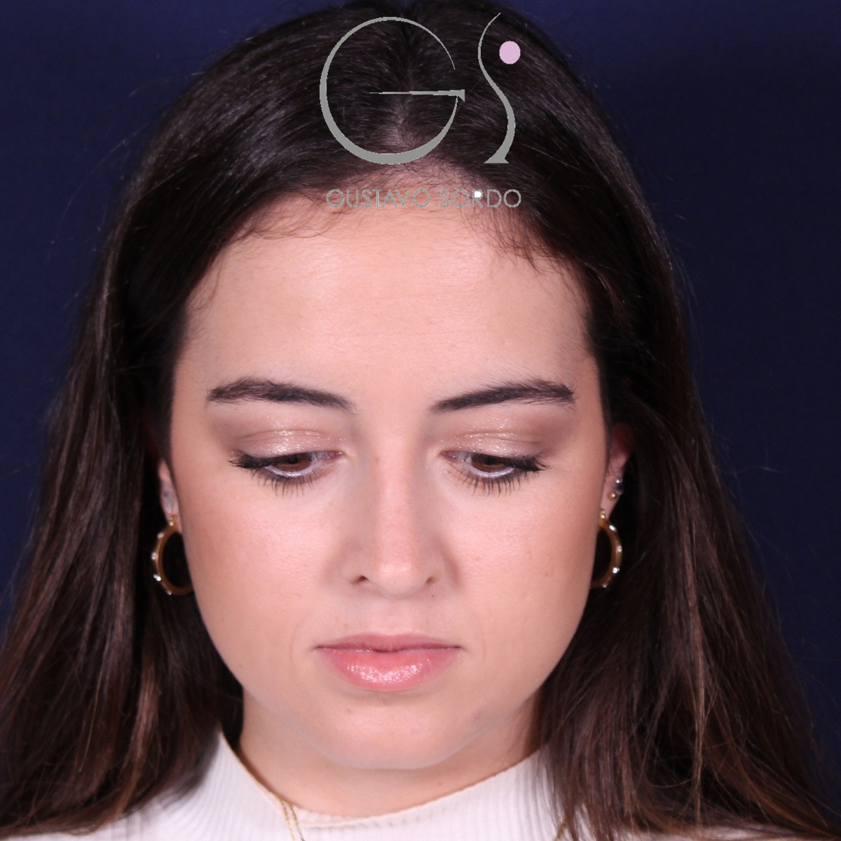 Rinoplastia ultrasónica en mujer con nariz aguileña, después de la operación (2)