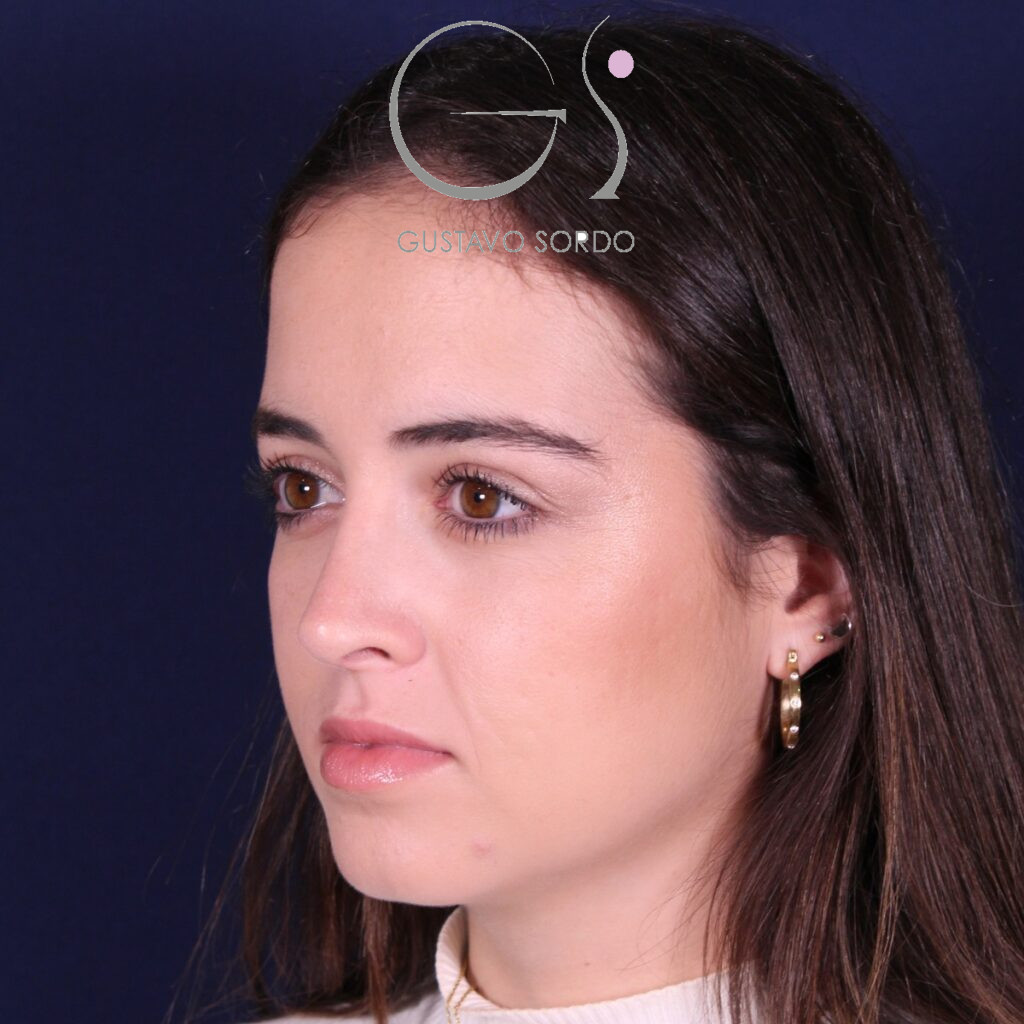 Rinoplastia ultrasónica en mujer con nariz aguileña, después de la operación (7)