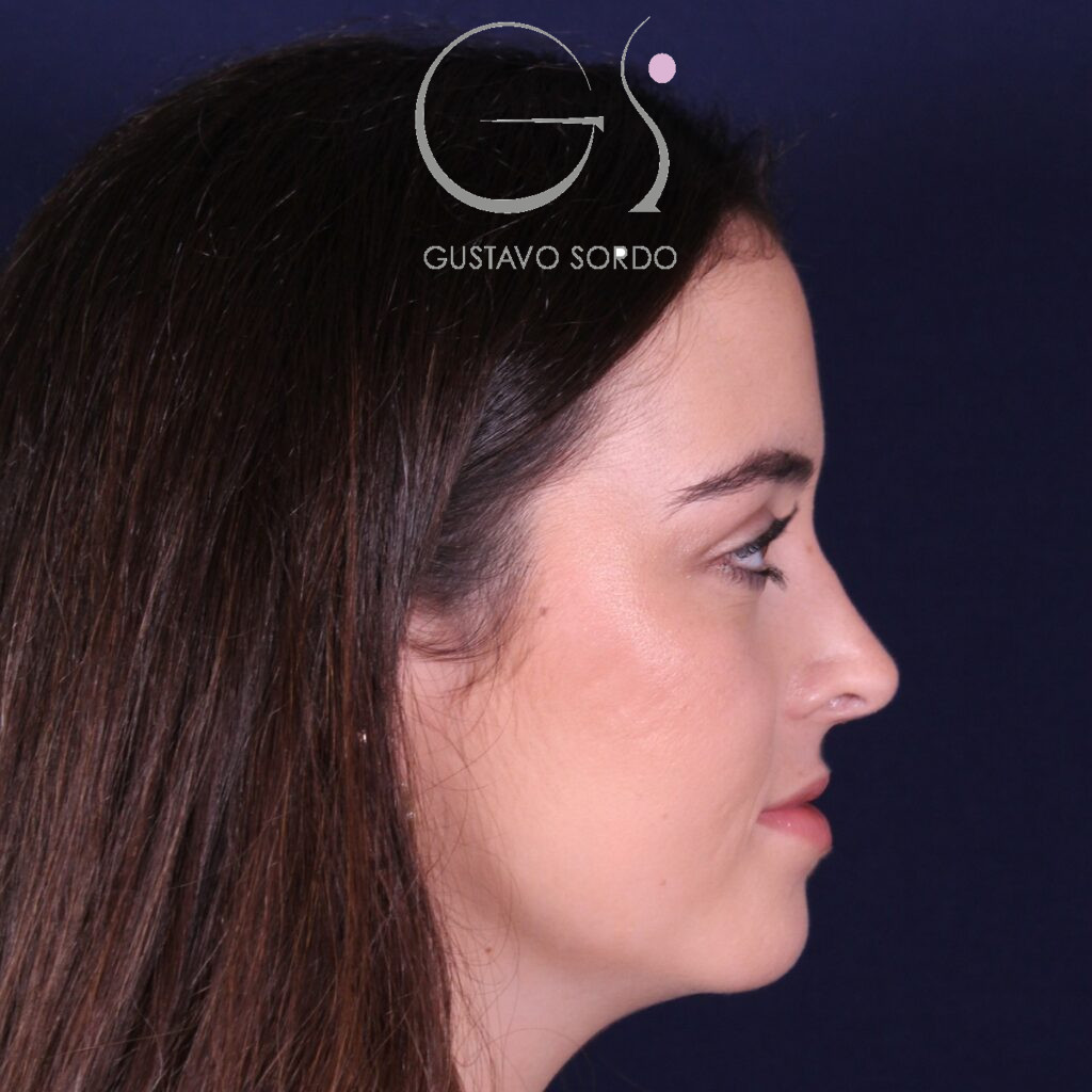 Rinoplastia ultrasónica en mujer con nariz aguileña, después de la operación (4)