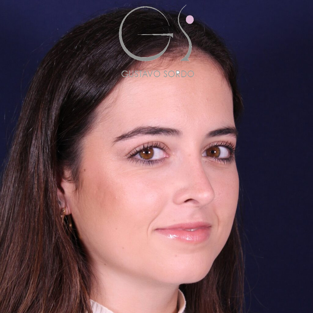 Rinoplastia ultrasónica en mujer con nariz aguileña, después de la operación (6)