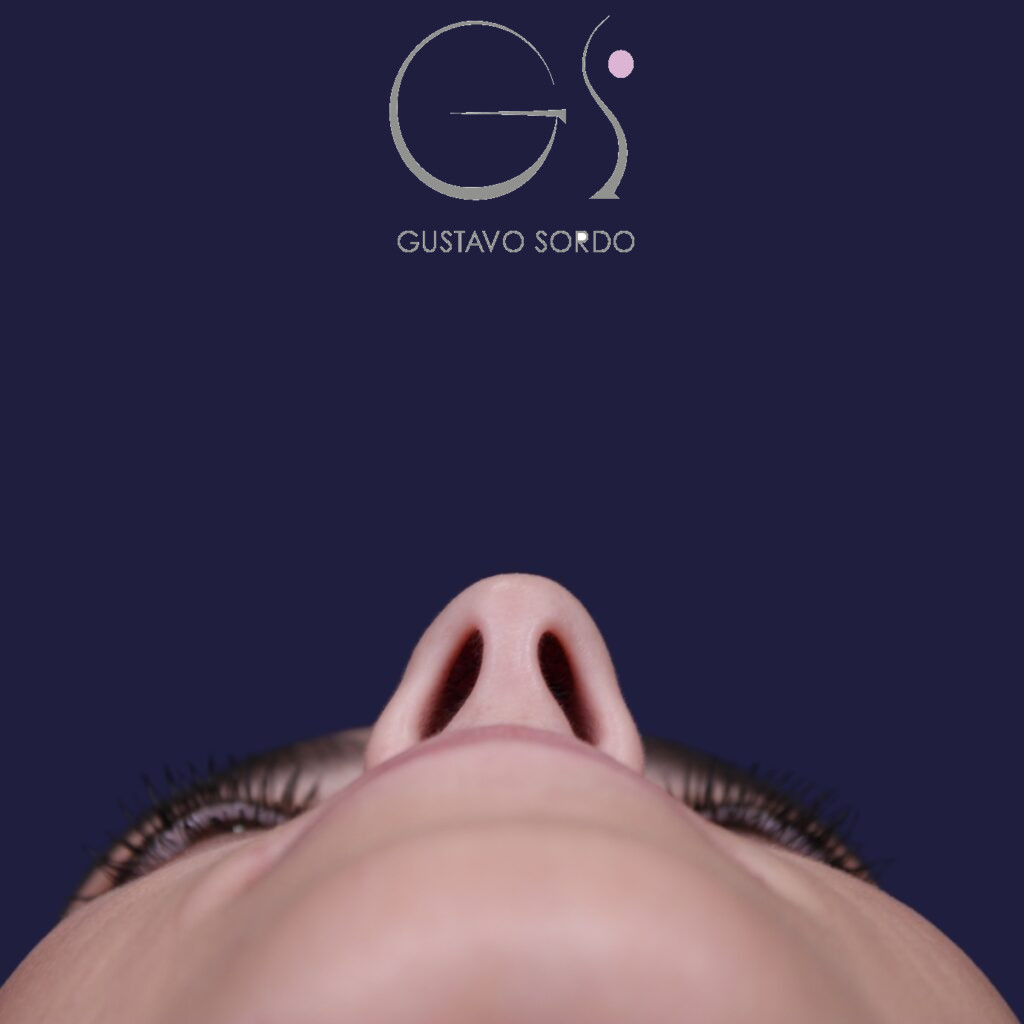 Rinoplastia ultrasónica en mujer con nariz aguileña, después de la operación (8)
