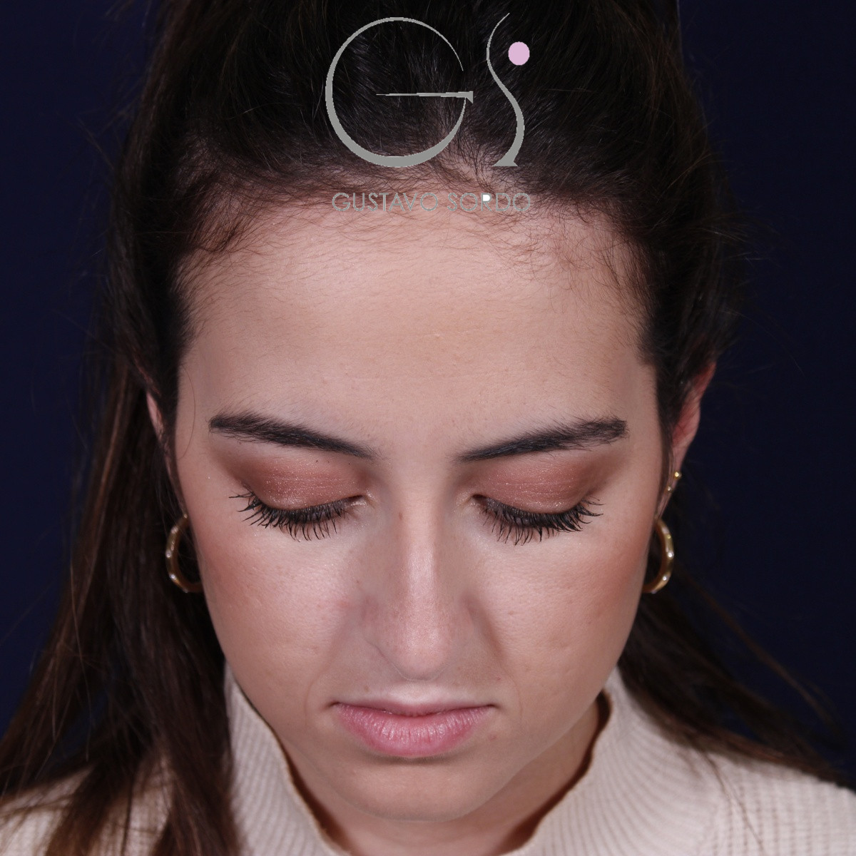 Rinoplastia ultrasónica en mujer con nariz aguileña, antes de la operación (2)