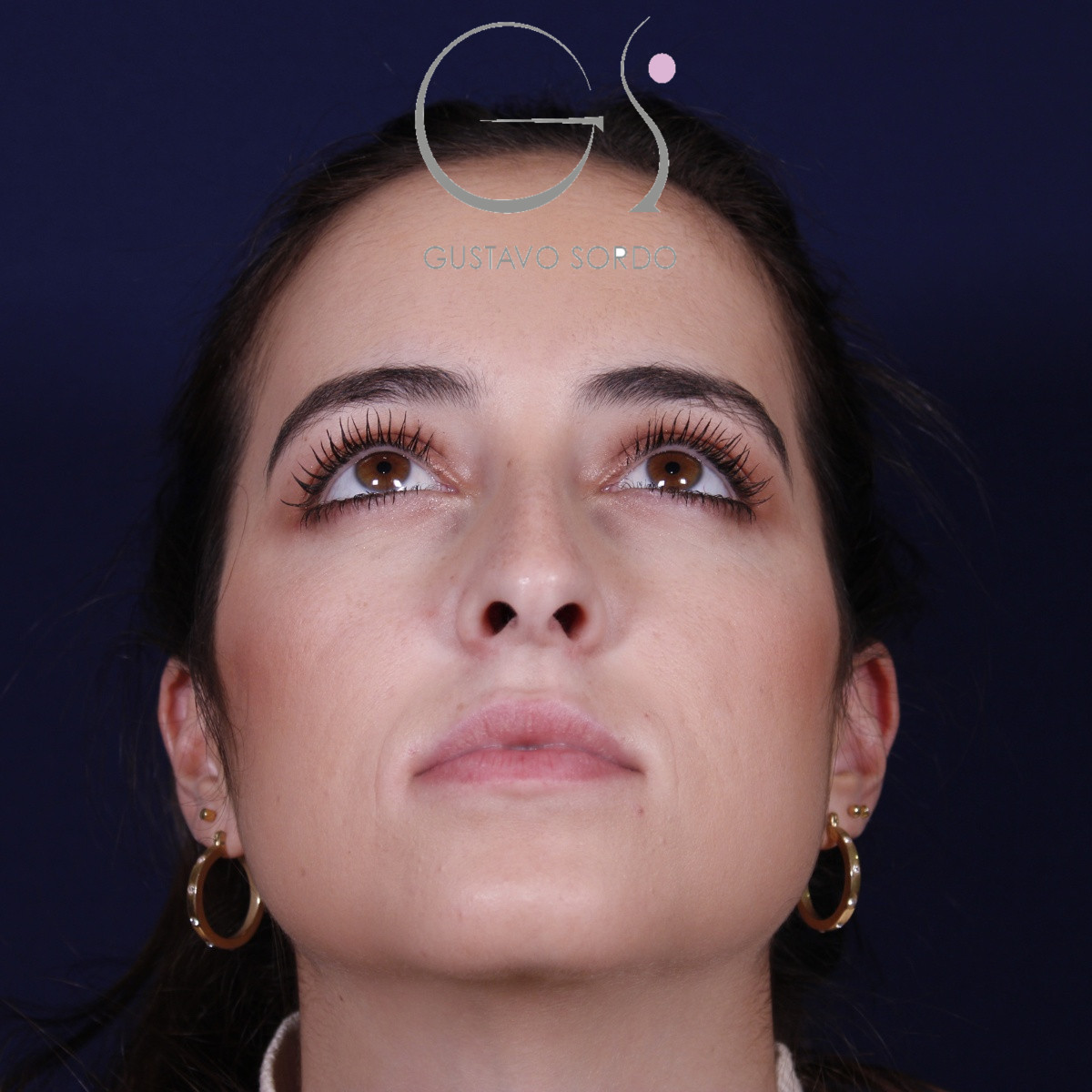 Rinoplastia ultrasónica en mujer con nariz aguileña, antes de la operación (3)