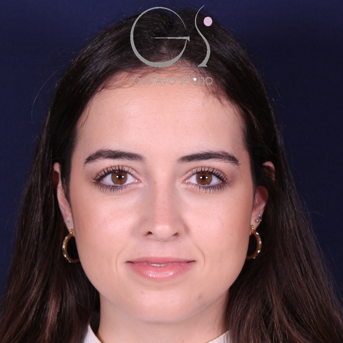 Rinoplastia ultrasónica en mujer con nariz aguileña, después de la operación (1)