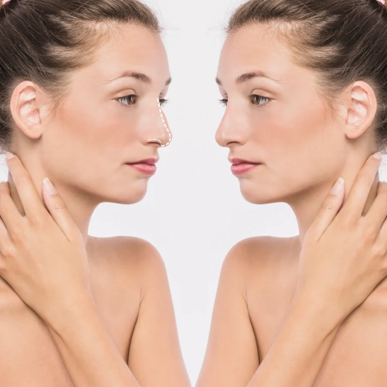 Rinoplastia en Madrid