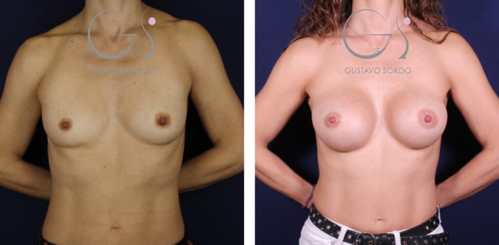 Aumento de pecho con implantes anatómicos de 345 cc: antes y después