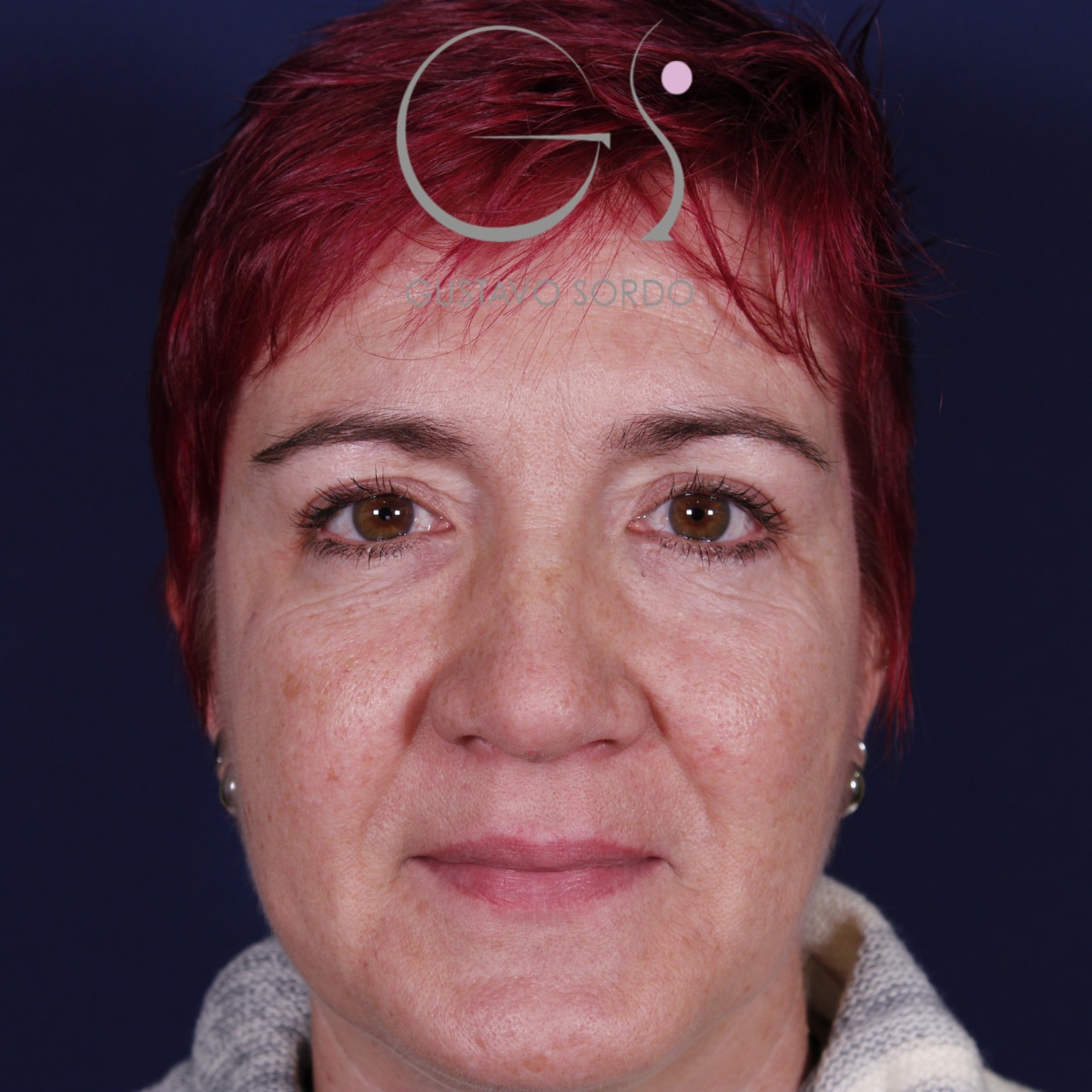 BLEFAROPLASTIA, antes de la cirugía — caso operado por el Dr. Gustavo Sordo en Madrid (1)