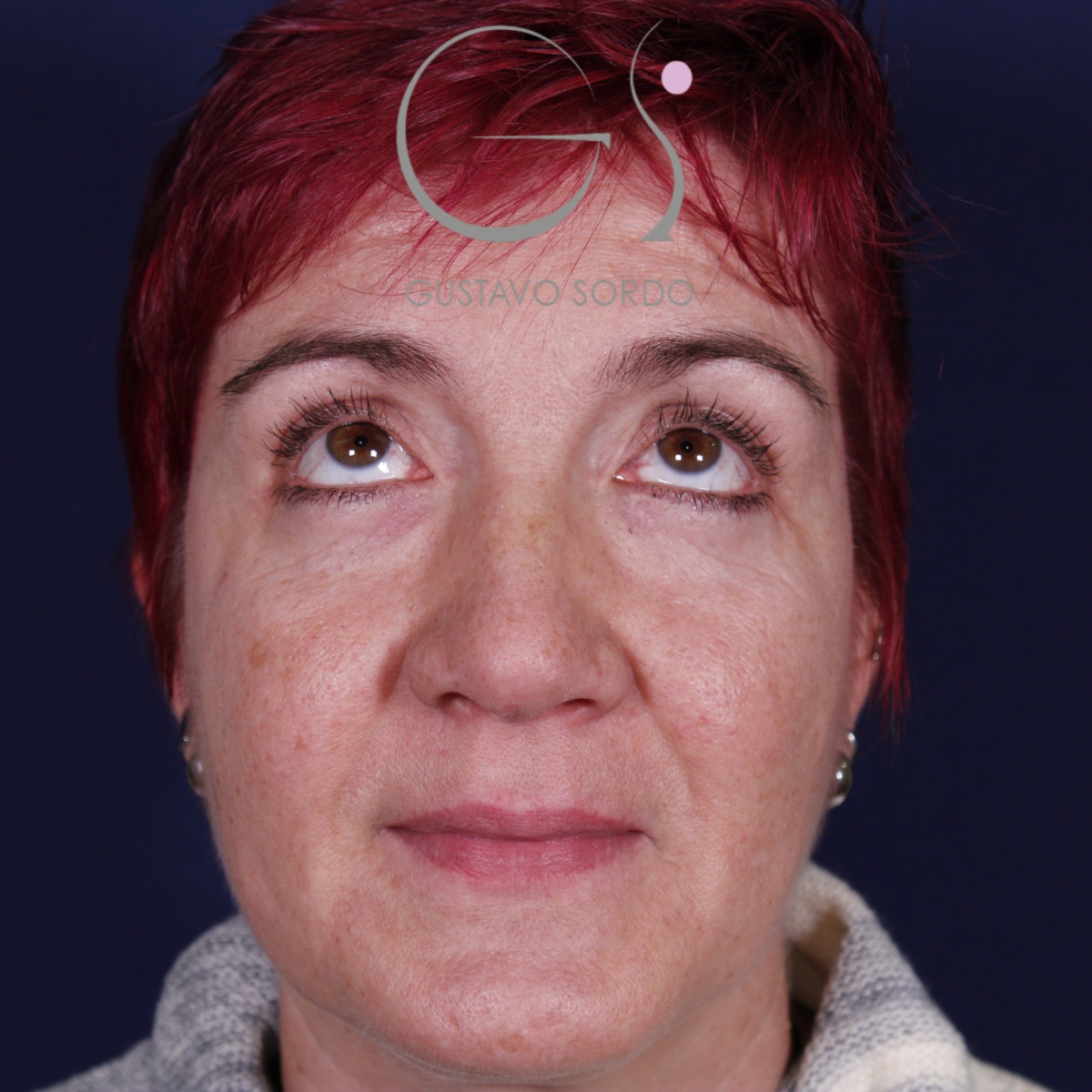 BLEFAROPLASTIA, antes de la cirugía — caso operado por el Dr. Gustavo Sordo en Madrid (2)