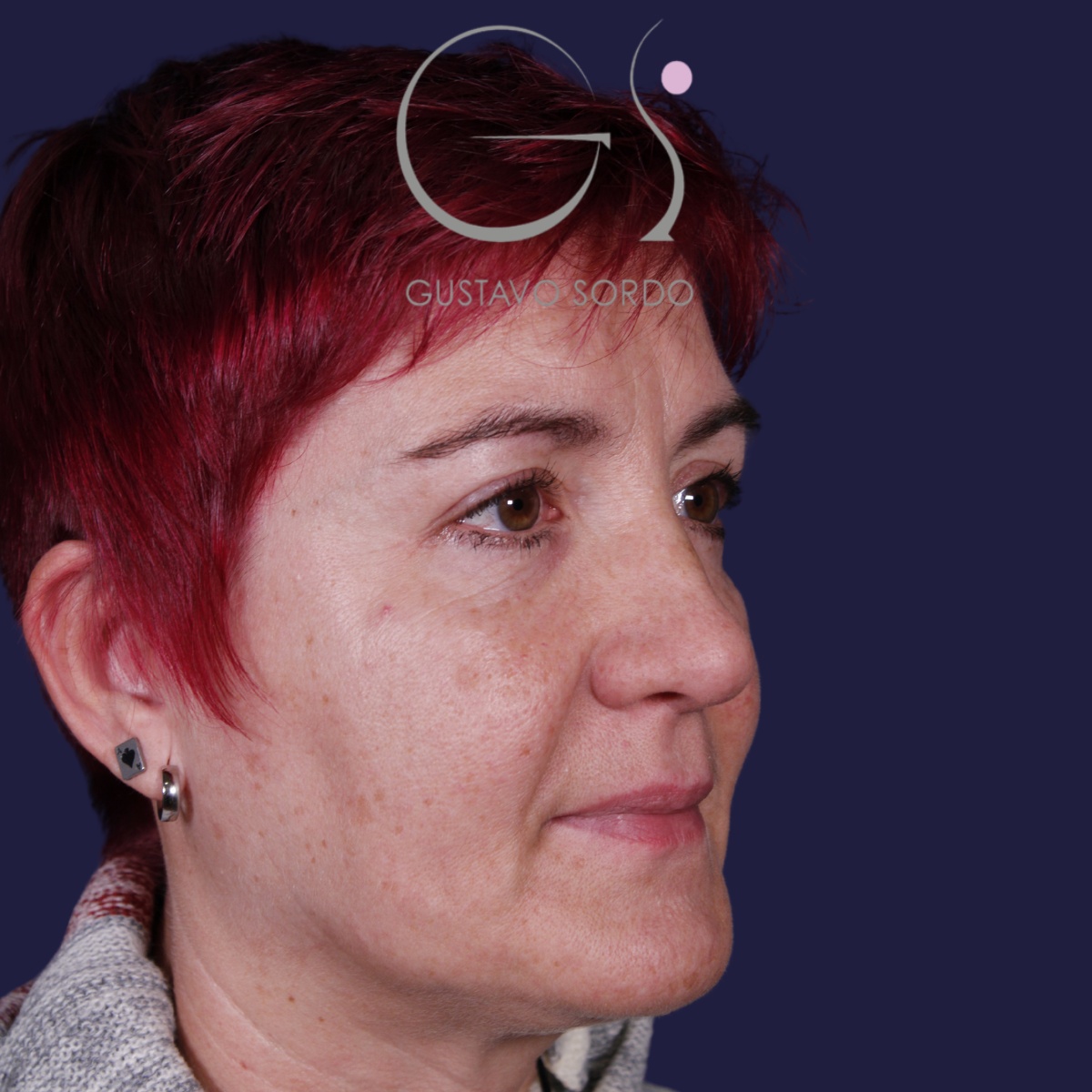 BLEFAROPLASTIA, antes de la cirugía — caso operado por el Dr. Gustavo Sordo en Madrid (3)