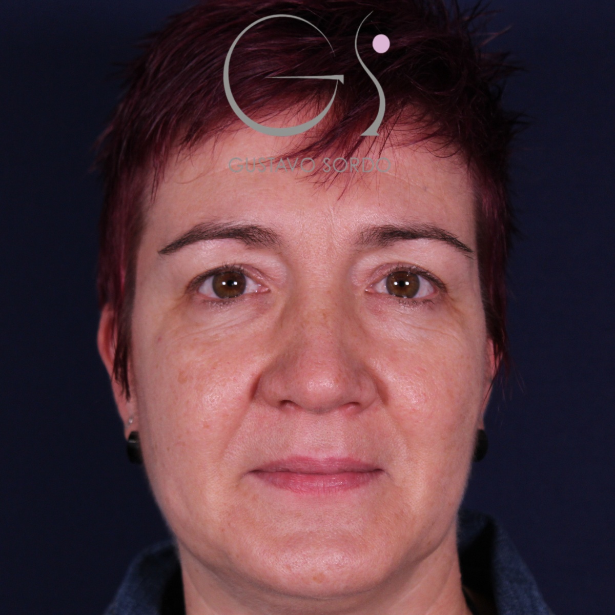 BLEFAROPLASTIA, resultado tras la cirugía — caso operado por el Dr. Gustavo Sordo en Madrid (1)