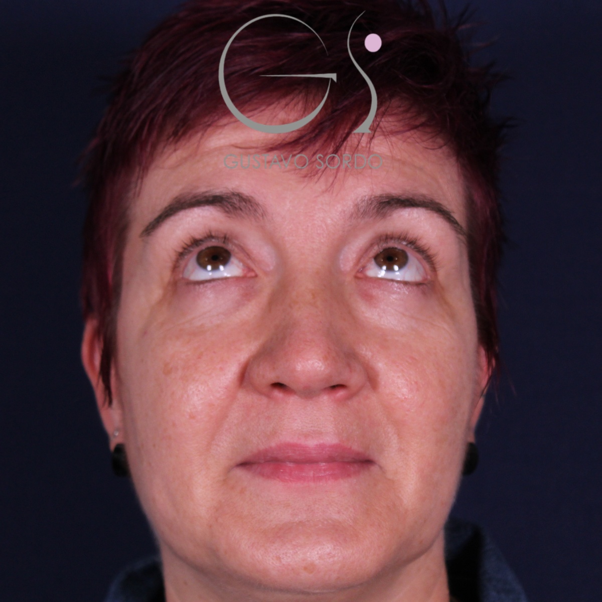 BLEFAROPLASTIA, resultado tras la cirugía — caso operado por el Dr. Gustavo Sordo en Madrid (2)