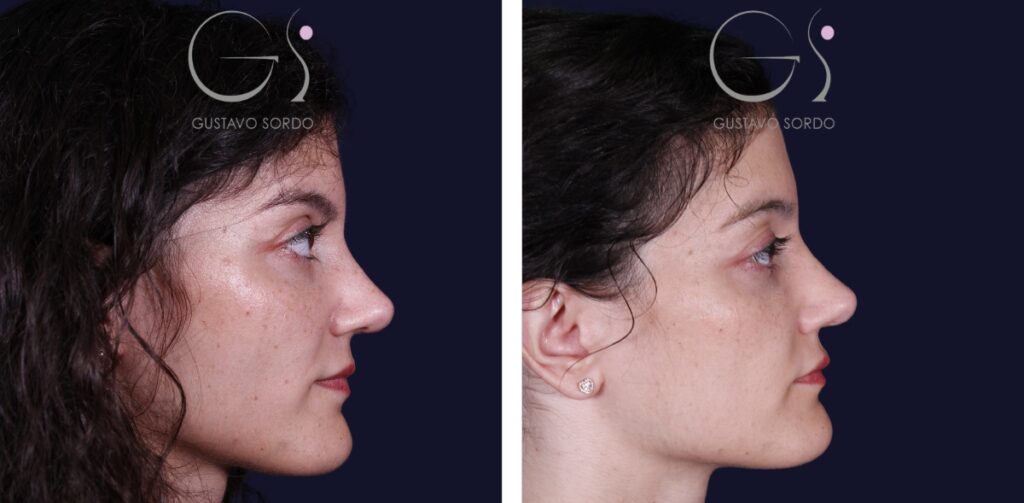 Rinoplastia — nariz bulbosa: antes y después de un caso operado en Madrid
