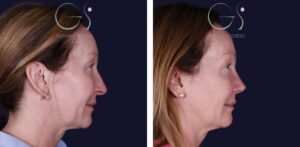 Rinoplastia — reducción de cornetes: antes y después de un caso operado en Madrid
