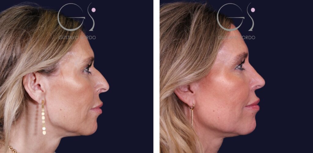 Rhinoplastie — peau épaisse&nbsp;: avant et après une intervention chirurgicale réalisée à Madrid