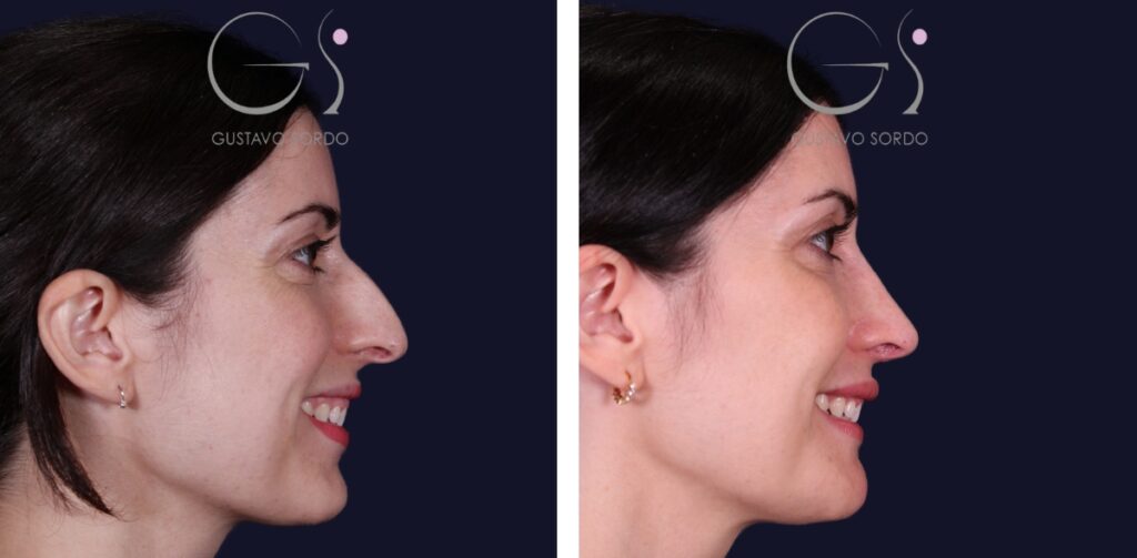 Rinoplastia: antes y después de un caso operado en Madrid