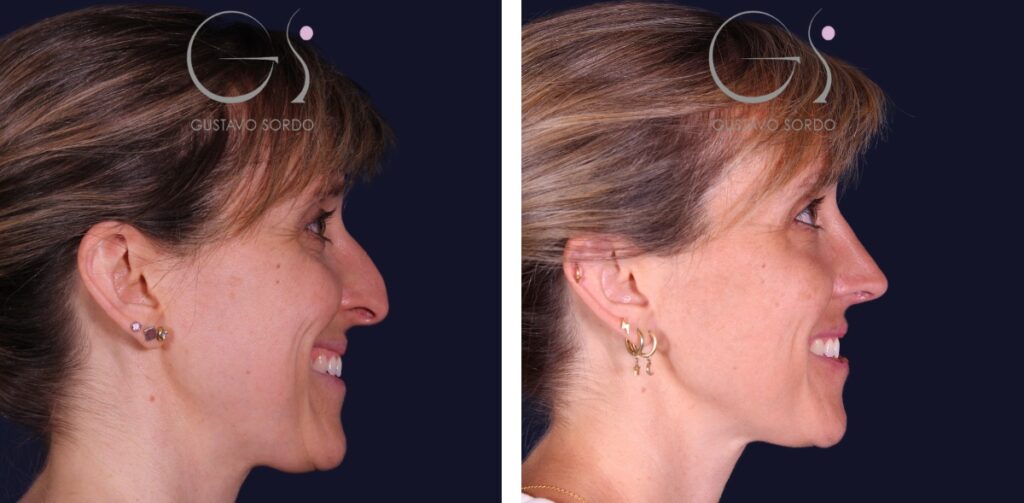 Rhinoplastie : avant et après une intervention réalisée à Madrid