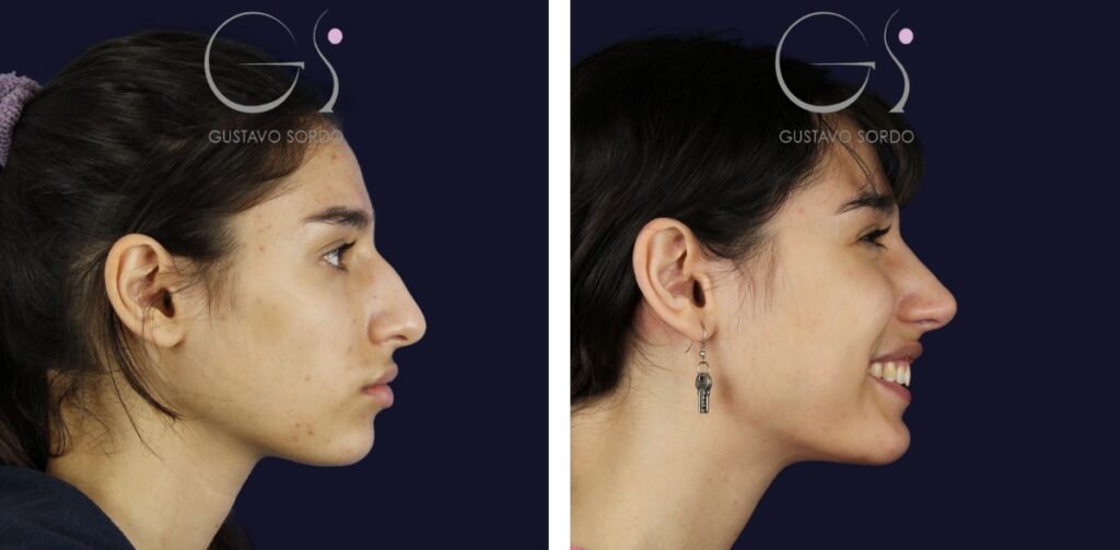 Rhinoplastie : avant et après une intervention réalisée à Madrid