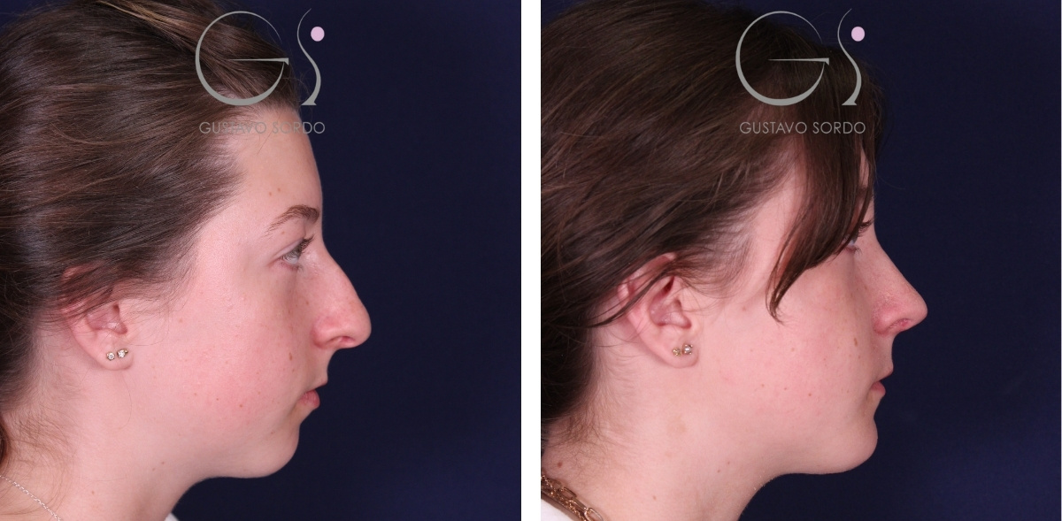 Antes y después de una rinoplastia con punta estructurada