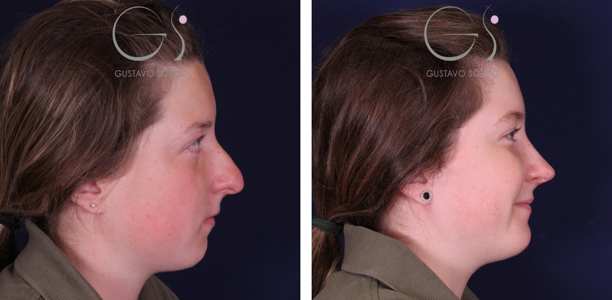 Resultado de rinoplastia de preservación, vista de perfil antes y después
