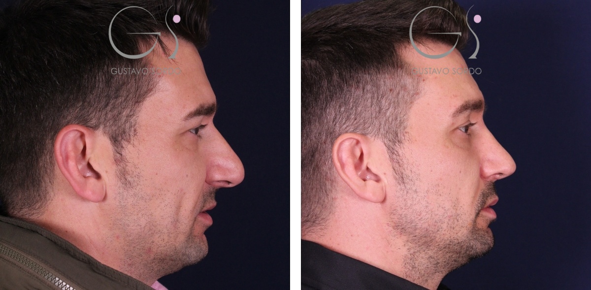 Antes y después de una rinoplastia de preservación realizada por el Dr. Gustavo Sordo