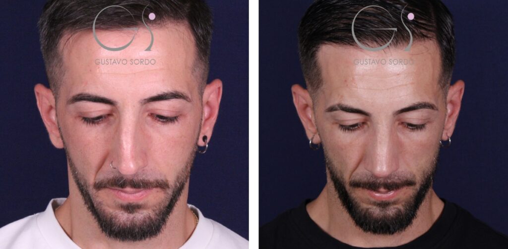 Rhinoplastie — déviation de la cloison nasale&nbsp;: avant et après une intervention réalisée à Madrid