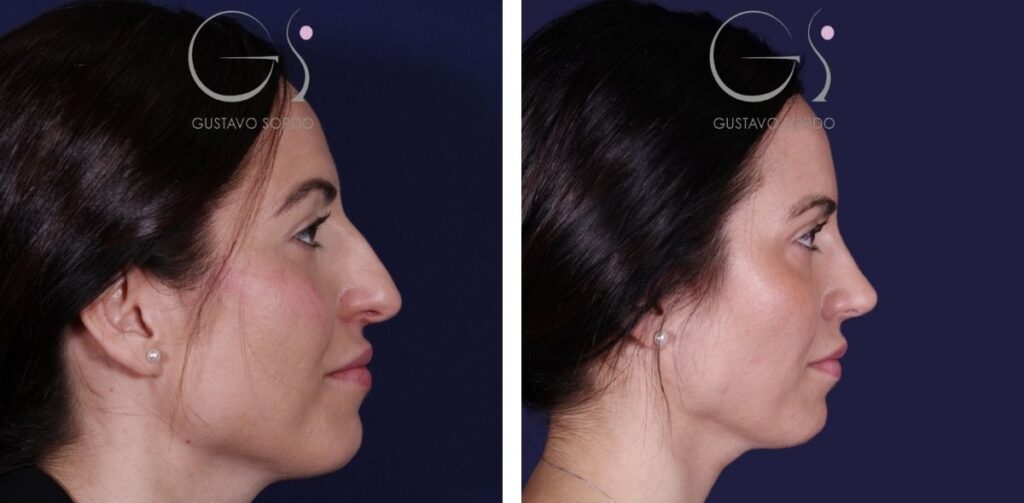 Rhinoplastie — déviation de la cloison nasale&nbsp;: avant et après une intervention réalisée à Madrid