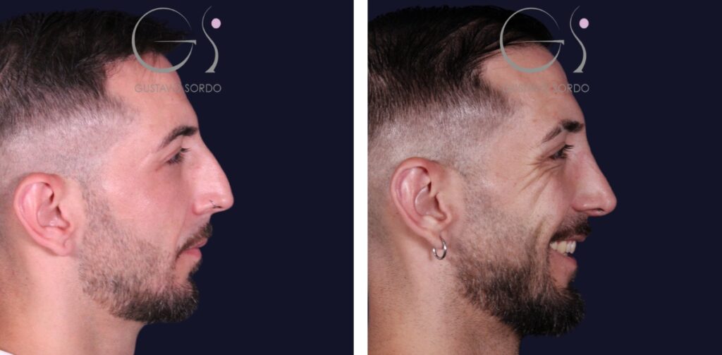 Rhinoplastie : avant et après une intervention réalisée à Madrid