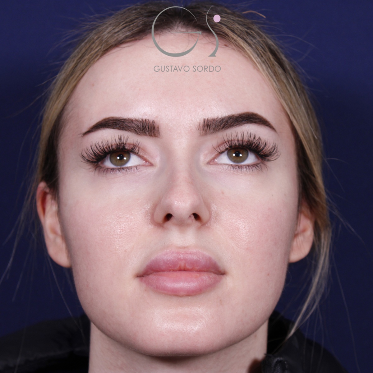 Rinoplastia — punta elevada: antes y después de un caso operado por el Dr. Gustavo Sordo en Madrid