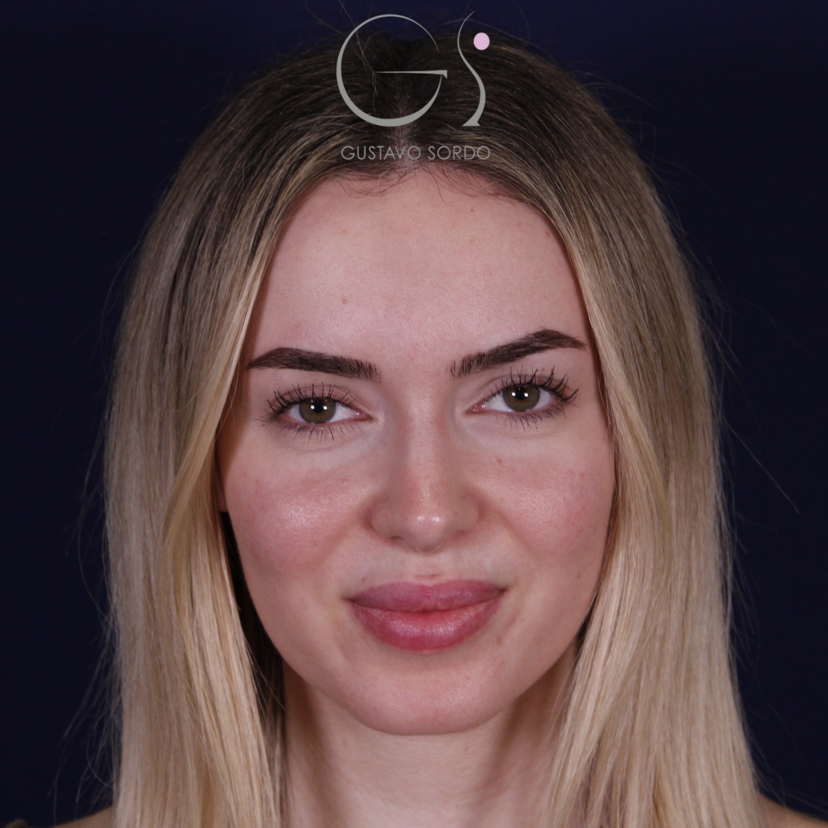 Rinoplastia — punta elevada: antes y después de un caso operado por el Dr. Gustavo Sordo en Madrid