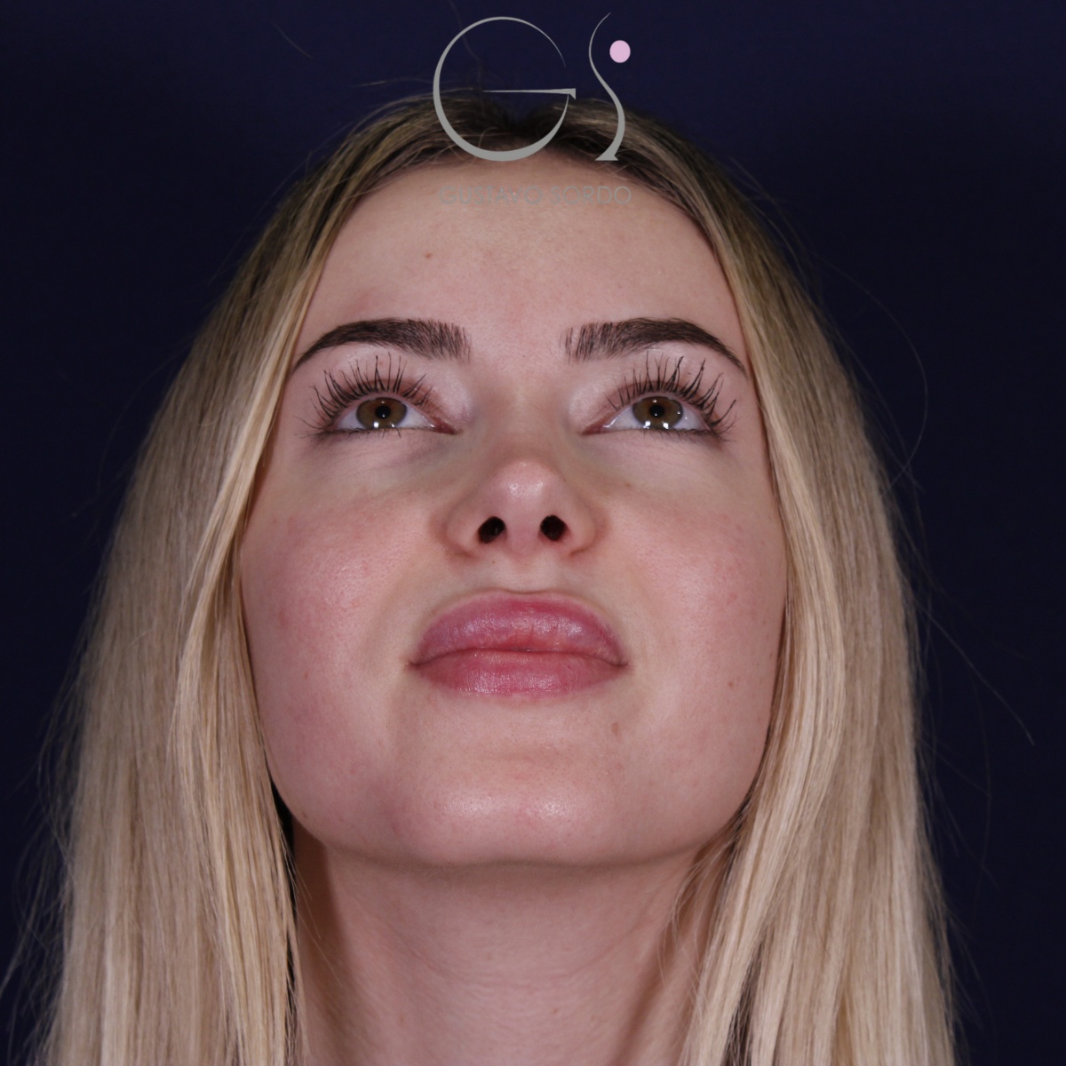 Rinoplastia — punta elevada: antes y después de un caso operado por el Dr. Gustavo Sordo en Madrid