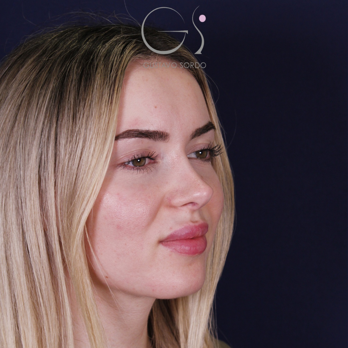 Rinoplastia — punta elevada: antes y después de un caso operado por el Dr. Gustavo Sordo en Madrid