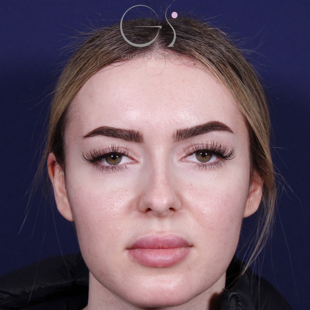 Rinoplastia — punta elevada: antes y después de un caso operado por el Dr. Gustavo Sordo en Madrid