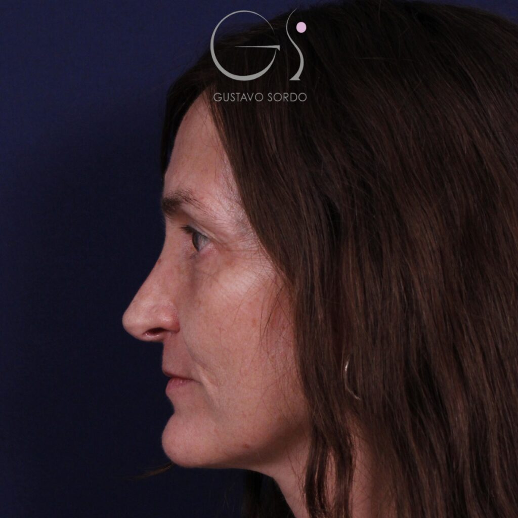 Rinoplastia, resultado tras la cirugía — caso operado por el Dr. Gustavo Sordo en Madrid (4)