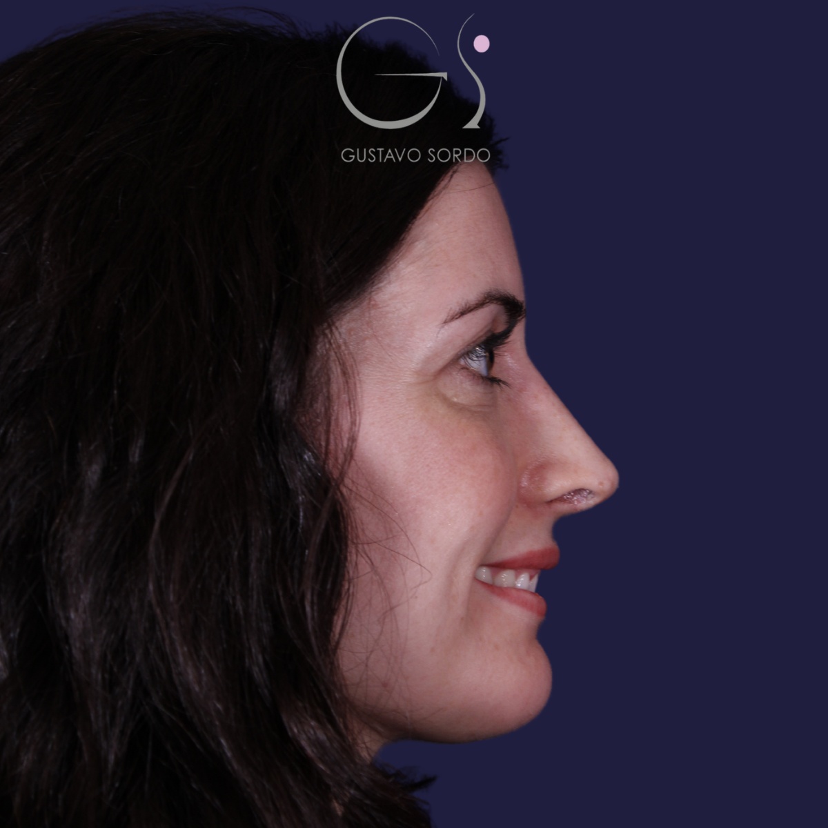 Perfil tras rinoplastia y mentoplastia, Dr. Gustavo Sordo