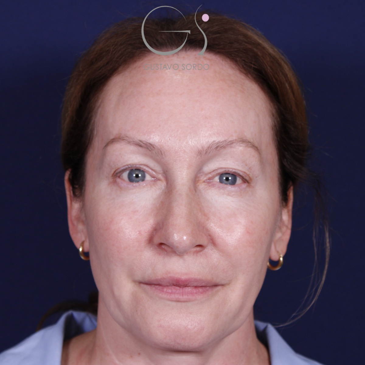 Rinoplastia: antes y después de un caso operado por el Dr. Gustavo Sordo en Madrid