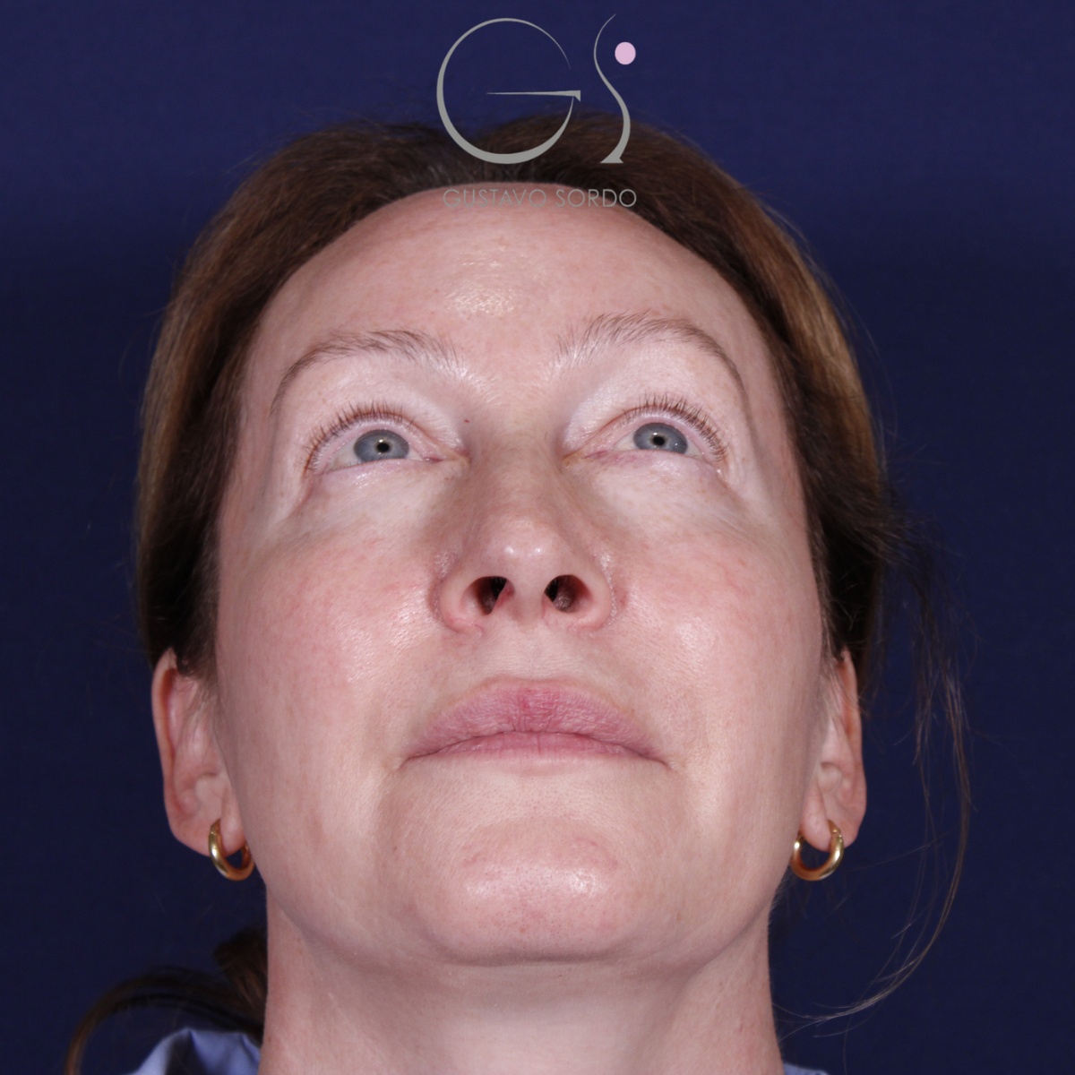 Rinoplastia: antes y después de un caso operado por el Dr. Gustavo Sordo en Madrid