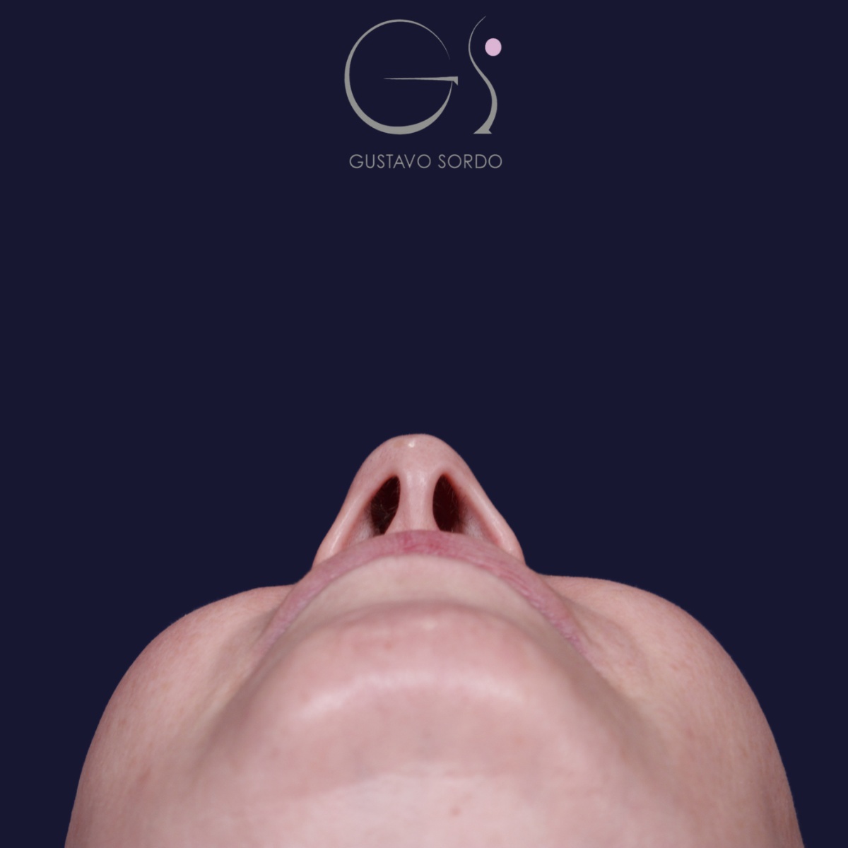 Rinoplastia: antes y después de un caso operado por el Dr. Gustavo Sordo en Madrid