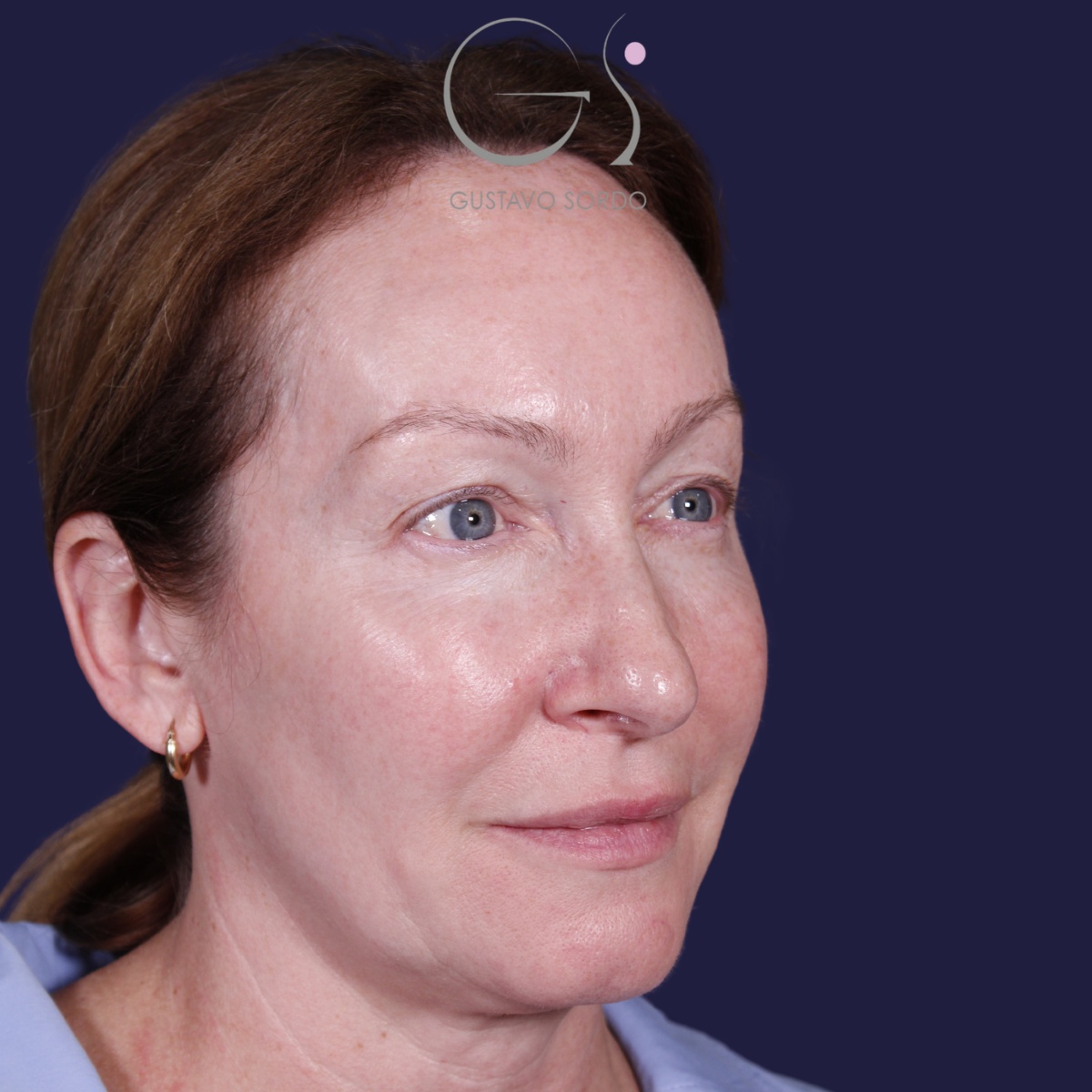 Rinoplastia: antes y después de un caso operado por el Dr. Gustavo Sordo en Madrid