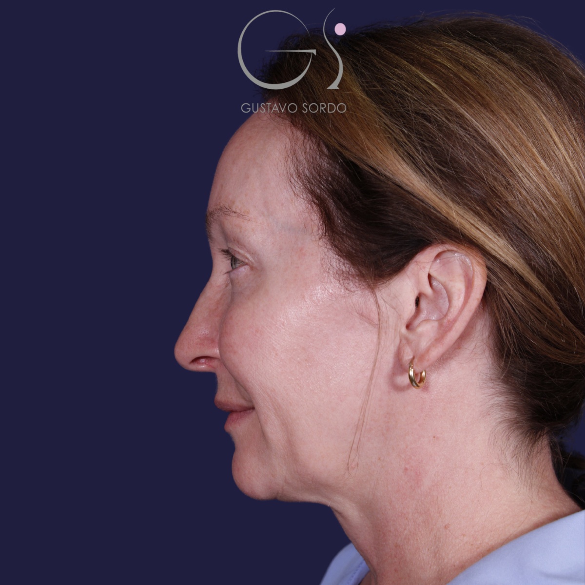 Rinoplastia: antes y después de un caso operado por el Dr. Gustavo Sordo en Madrid