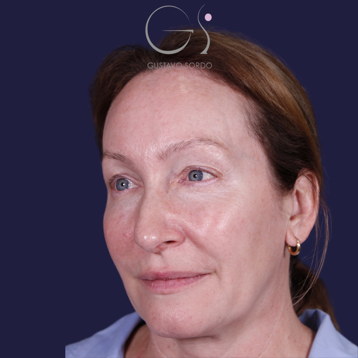 Rinoplastia: antes y después de un caso operado por el Dr. Gustavo Sordo en Madrid