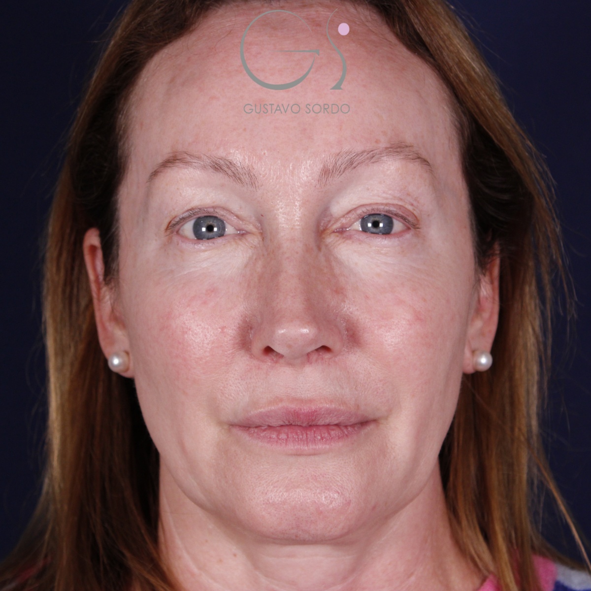 Rinoplastia: antes y después de un caso operado por el Dr. Gustavo Sordo en Madrid