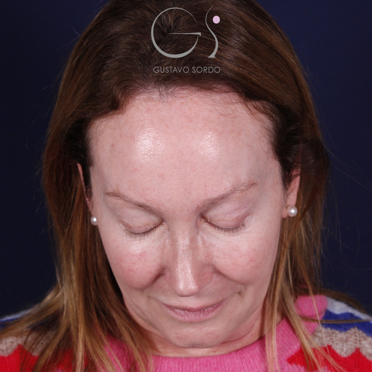Rinoplastia: antes y después de un caso operado por el Dr. Gustavo Sordo en Madrid