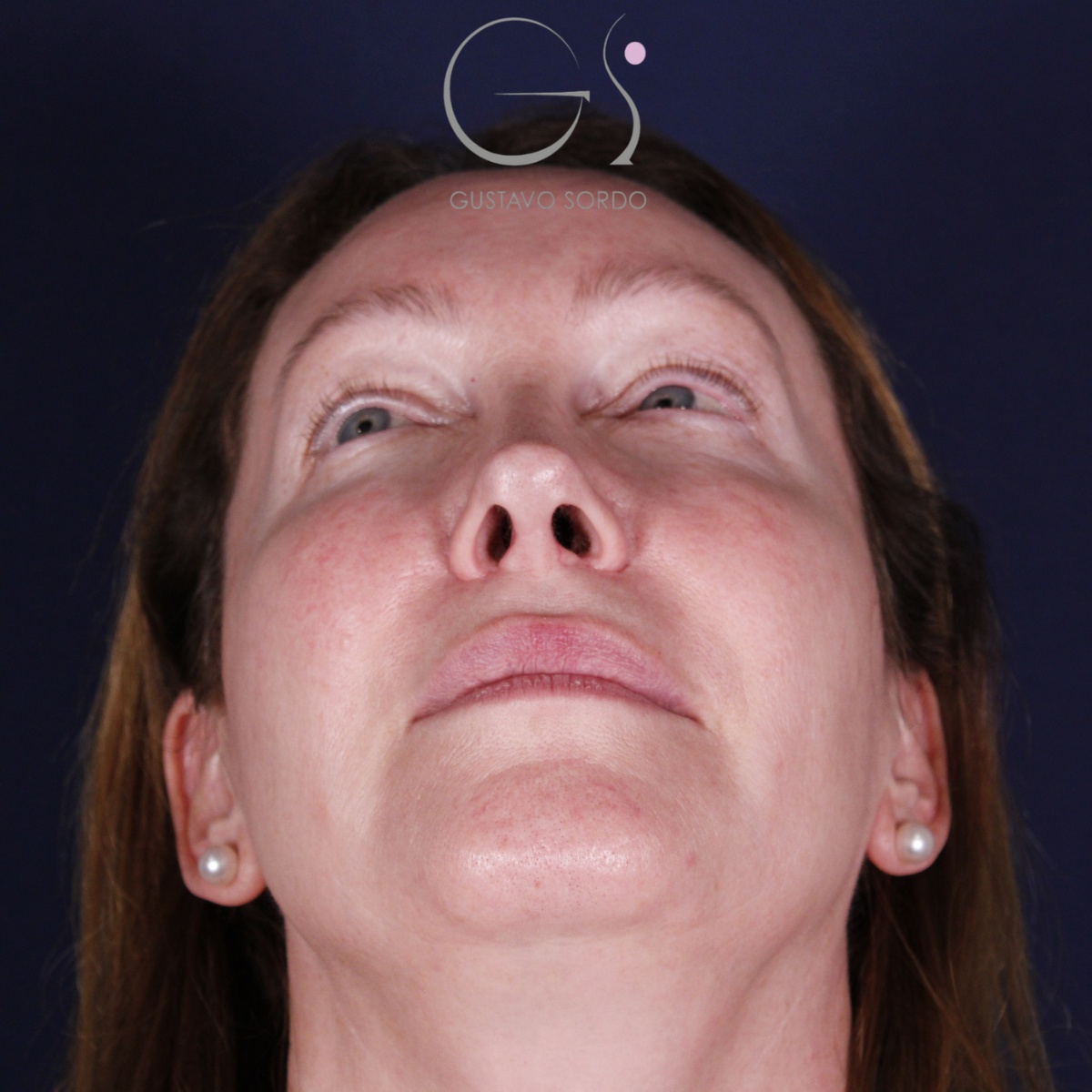 Rinoplastia: antes y después de un caso operado por el Dr. Gustavo Sordo en Madrid